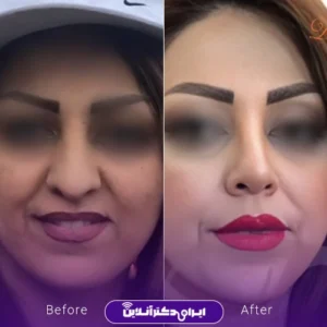 نمونه کار عمل بینی دکتر فرید عطار 7