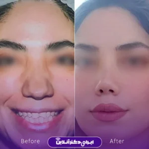 نمونه کار عمل بینی دکتر فرید عطار 6