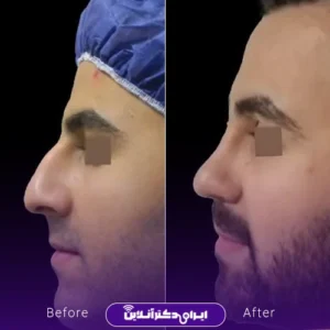نمونه کار عمل بینی دکتر محمود تقی زاده 6