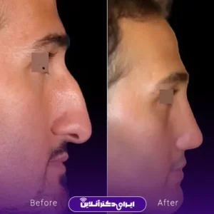 نمونه کار عمل بینی دکتر محمود تقی زاده 10