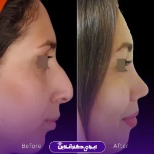 نمونه کار عمل بینی دکتر محمود تقی زاده 2