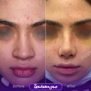 نمونه کار عمل بینی دکتر مهشید خورده چی 10
