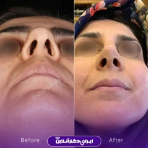 نمونه کار عمل بینی دکتر مهشید خورده چی 5