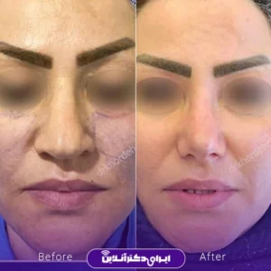 نمونه کار عمل بینی دکتر مهشید خورده چی 6