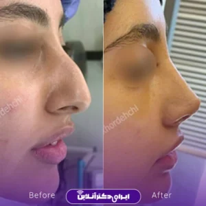 نمونه کار عمل بینی دکتر مهشید خورده چی 7