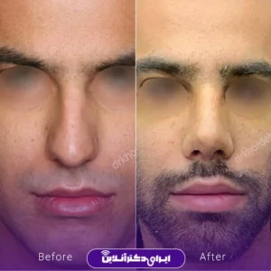 نمونه کار عمل بینی دکتر مهشید خورده چی 8