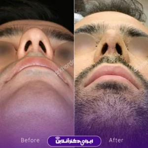 نمونه کار عمل بینی دکتر مهشید خورده چی 9