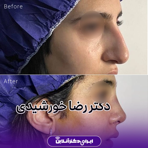 بهترین جراح بینی در تبریز + راهنمای عمل بینی سال 1405 75 نمونه کار قبل و بعد جراحی بینی دکتر رضا خورشیدی خیاوی 3
