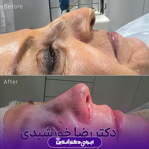 بهترین جراح بینی در تبریز + راهنمای عمل بینی سال 1405 73 نمونه کار قبل و بعد جراحی بینی دکتر رضا خورشیدی خیاوی 1