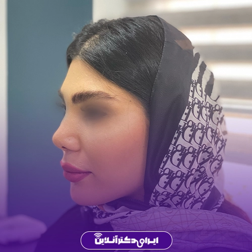 بهترین جراح بینی در تبریز + راهنمای عمل بینی سال 1405 76 نمونه کار قبل و بعد جراحی بینی دکتر رضا خورشیدی خیاوی 4
