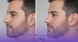 راهنمای رفع قوز بینی بدون جراحی