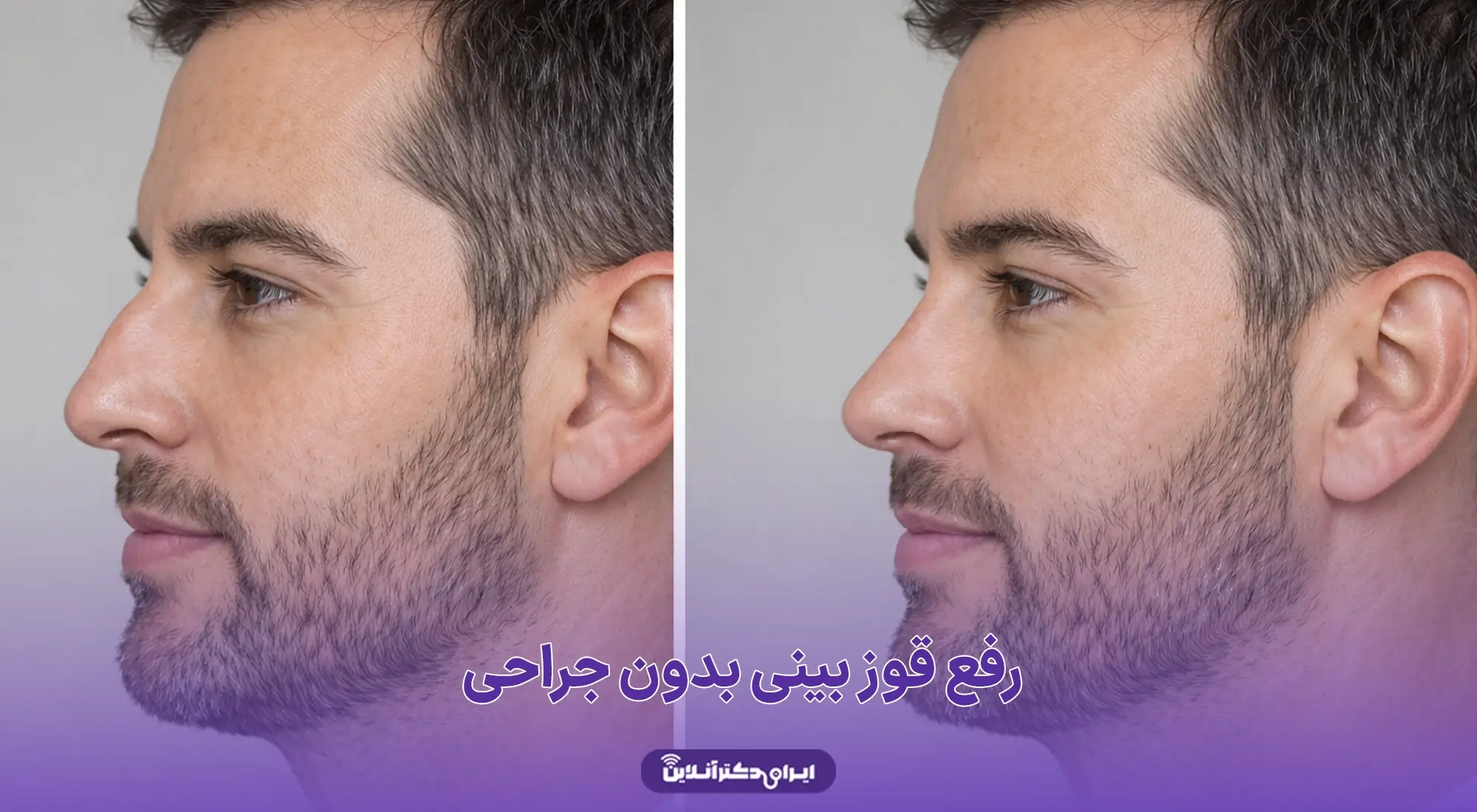 ایران دکتر آنلاین | ویزیت و مشاوره آنلاین 71 راهنمای رفع قوز بینی بدون جراحی