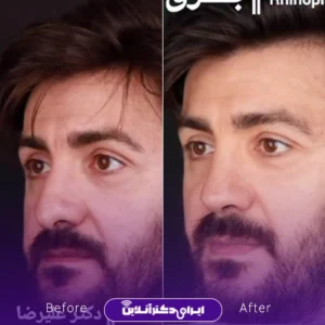 نمونه کار عمل بینی دکتر علیرضا برق 1