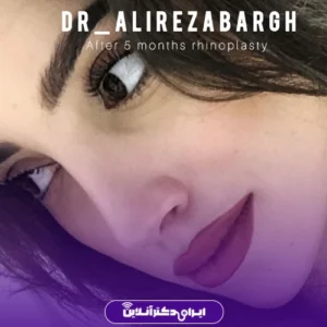 نمونه کار عمل بینی دکتر علیرضا برق 3