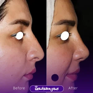 نمونه کار عمل بینی دکتر ماکان شالچی زاده 1