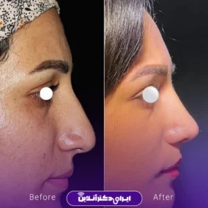 نمونه کار عمل بینی دکتر ماکان شالچی زاده 2