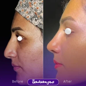 نمونه کار عمل بینی دکتر ماکان شالچی زاده 4