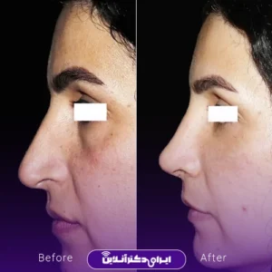 نمونه کار عمل بینی دکتر ماکان شالچی زاده 5