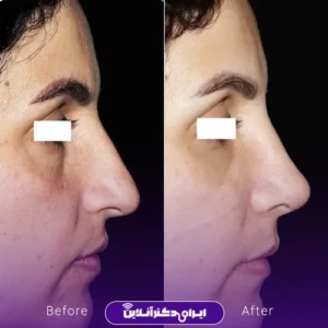 نمونه کار عمل بینی دکتر ماکان شالچی زاده 6
