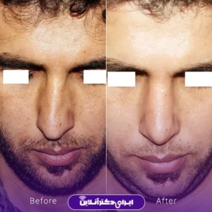 نمونه کار عمل بینی دکتر ماکان شالچی زاده 7