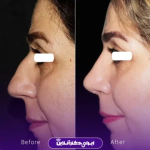 نمونه کار عمل بینی دکتر ماکان شالچی زاده 8