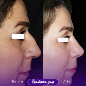 نمونه کار عمل بینی دکتر ماکان شالچی زاده 9