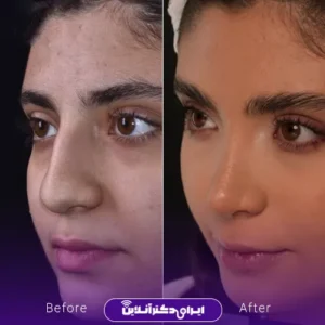نمونه کار دکتر سارا ارژنگ قبل و بعد از عمل بینی در تهران
