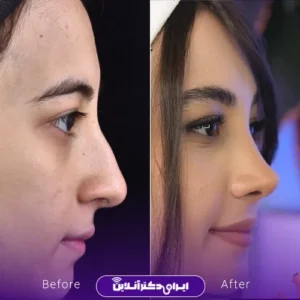 نمونه کار قبل و بعد از عمل بینی توسط دکتر سارا ارژنگ در تهران