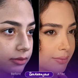 عکس قبل و بعد از عمل بینی توسط دکتر سارا ارژنگ در تهران