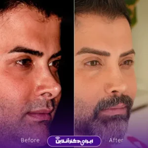 قبل و بعد از عمل بینی دکتر سارا ارژنگ در تهران