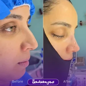 نمونه کار عمل بینی دکتر علیرضا سلطانی فر 10