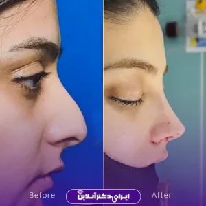 نمونه کار عمل بینی دکتر علیرضا سلطانی فر 8