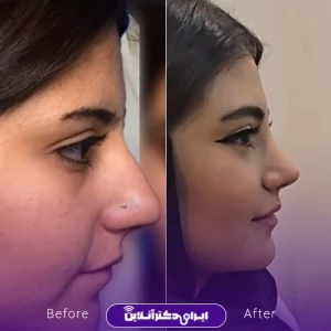 نمونه کار عمل بینی دکتر علیرضا سلطانی فر 9