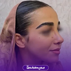 نمونه کار عمل بینی دکتر حبیب سهرابی 1