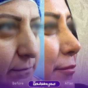 نمونه کار عمل بینی دکتر حبیب سهرابی 2