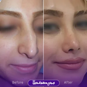 نمونه کار عمل بینی دکتر حبیب سهرابی 3