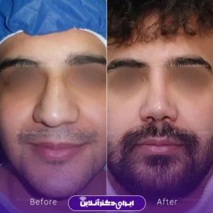 نمونه کار عمل بینی دکتر حبیب سهرابی 4