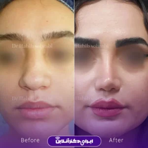 نمونه کار عمل بینی دکتر حبیب سهرابی 5