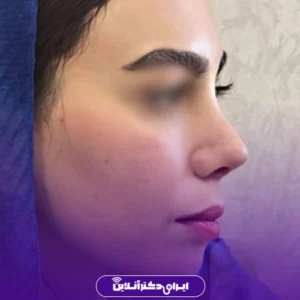 نمونه کار عمل بینی دکتر حبیب سهرابی 9
