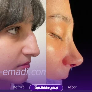 نمونه کار جراحی بینی دکتر مجید عمادی 1