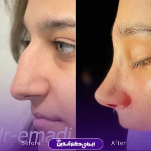 نمونه کار جراحی بینی دکتر مجید عمادی 2