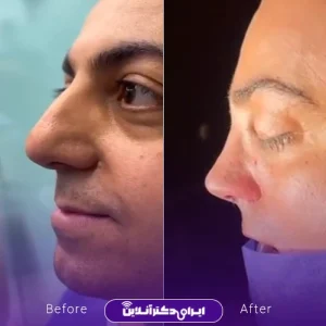 نمونه کار جراحی بینی دکتر مجید عمادی 3
