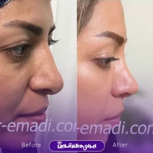 نمونه کار جراحی بینی دکتر مجید عمادی 4