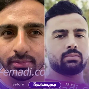نمونه کار جراحی بینی دکتر مجید عمادی 5