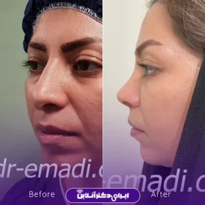 نمونه کار جراحی بینی دکتر مجید عمادی 6