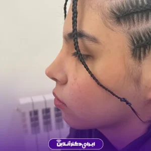 نمونه کار جراحی بینی دکتر رضا ساریخانی2