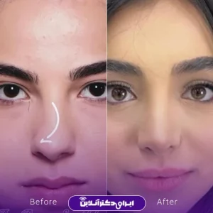 نمونه کار جراحی بینی دکتر رضا ساریخانی 3