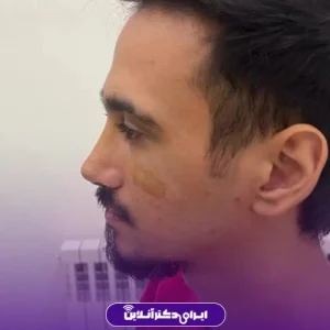 نمونه کار جراحی بینی دکتر رضا ساریخانی 6