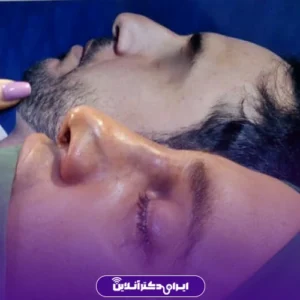 نمونه کار عمل بینی دکتر مهرداد امیرآبادی شیراز 2