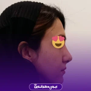 نمونه کار عمل بینی دکتر مهرداد امیرآبادی شیراز 3